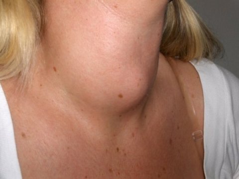 vrouw met schildklierknobbel
